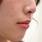 大阪でほくろ除去の取り放題が安いおすすめクリニック16選｜梅田・難波・道頓堀の人気クリニックを徹底比較