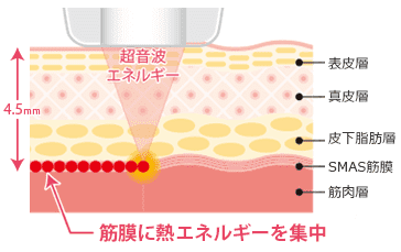 品川美容外科（品川美容外科） ハイフ 筋膜に熱エネルギーを集中