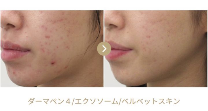 TAクリニックダーマペンの口コミを調査！ヴェルベットスキンやエクソソームに定評あり | Beauty Park