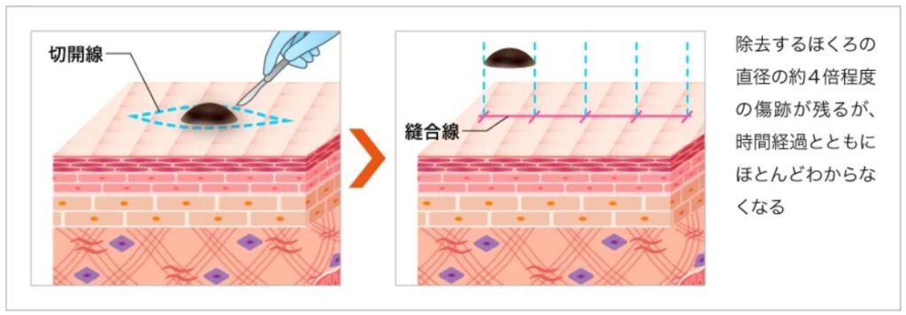 TCB東京中央美容外科 切開法でのほくろ除去