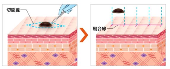 切開でのほくろ除去