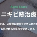 【メンズ】男性におすすめのニキビ・ニキビ跡治療4選｜何をしても治らない方に人気の施術を紹介