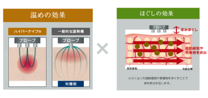 どっちが痩せる？ハイパーナイフとキャビテーションの違いとメリット  