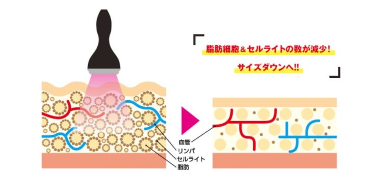 キャビテーション仕組み