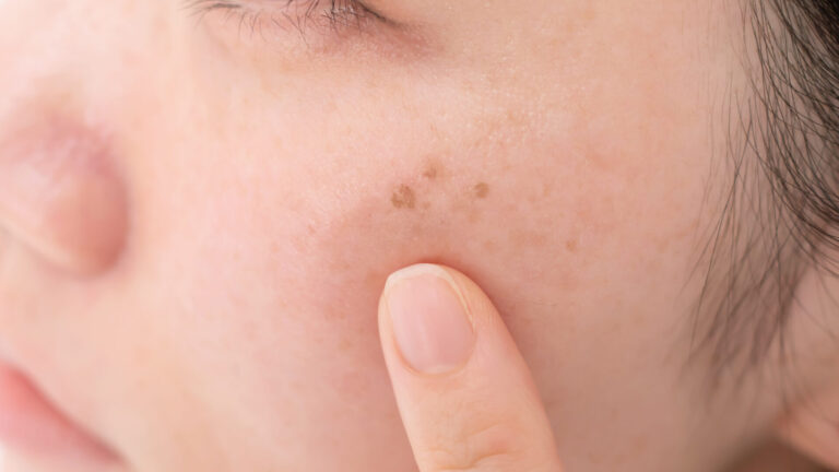シミ取りはどっちに行くべき？皮膚科と美容皮膚科の違いとおすすめを解説