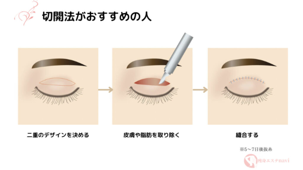  二重整形　切開法