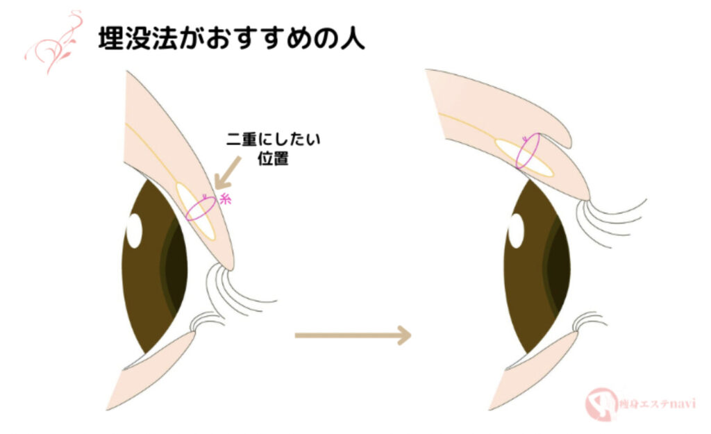 二重整形　埋没法