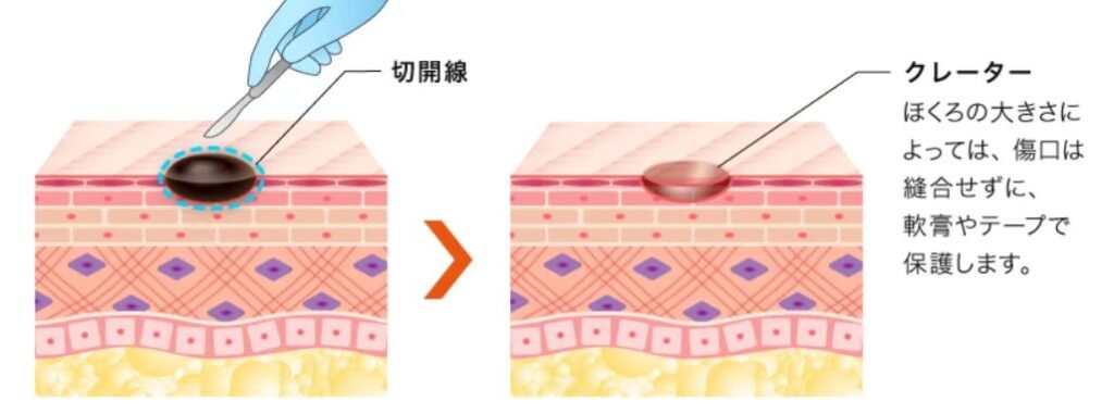 ほくろ除去は皮膚科と美容外科どっち？