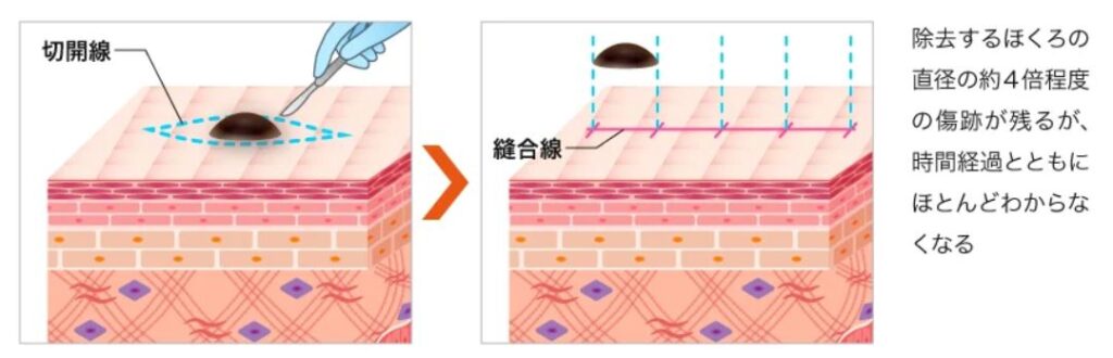 ほくろ除去は皮膚科と美容外科どっち？