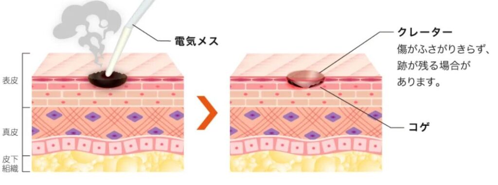 ほくろ除去は皮膚科と美容外科どっち？