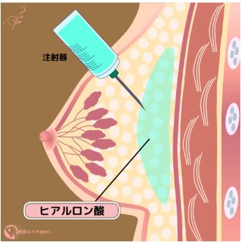 ヒアルロン酸豊胸