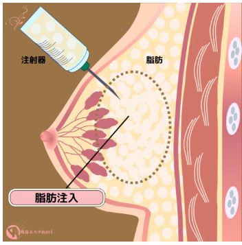 脂肪注入豊胸