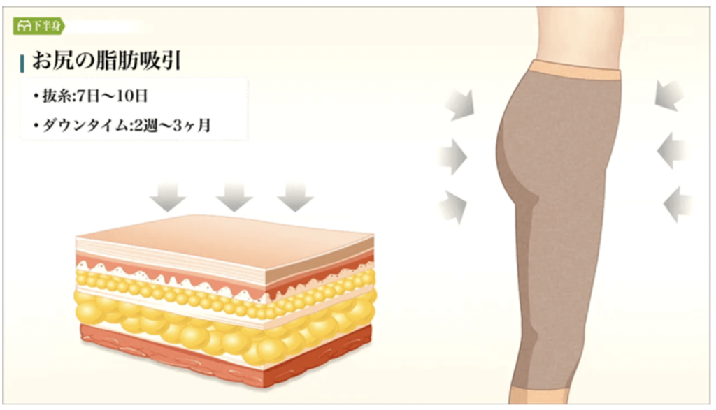 お尻　脂肪吸引