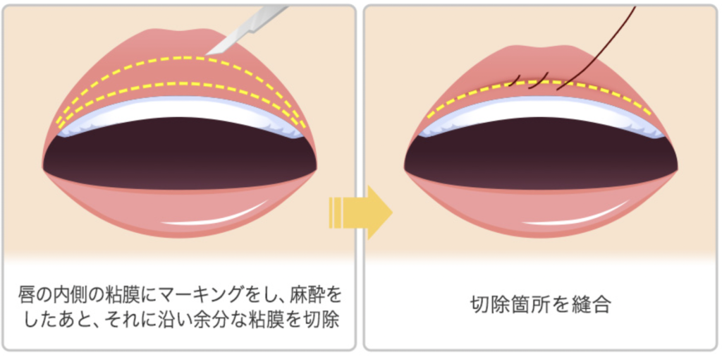 唇を薄くする整形