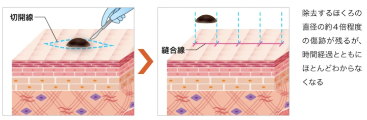 ほくろ除去 熊本