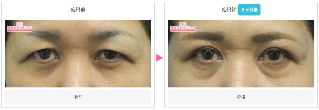 瞼の脂肪取りが安いおすすめのクリニック6選|バレにくい方法も紹介 | Beauty Park Clinic