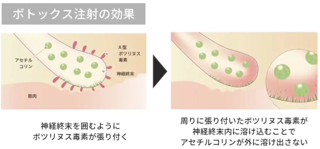 脇汗ボトックス注射 大阪