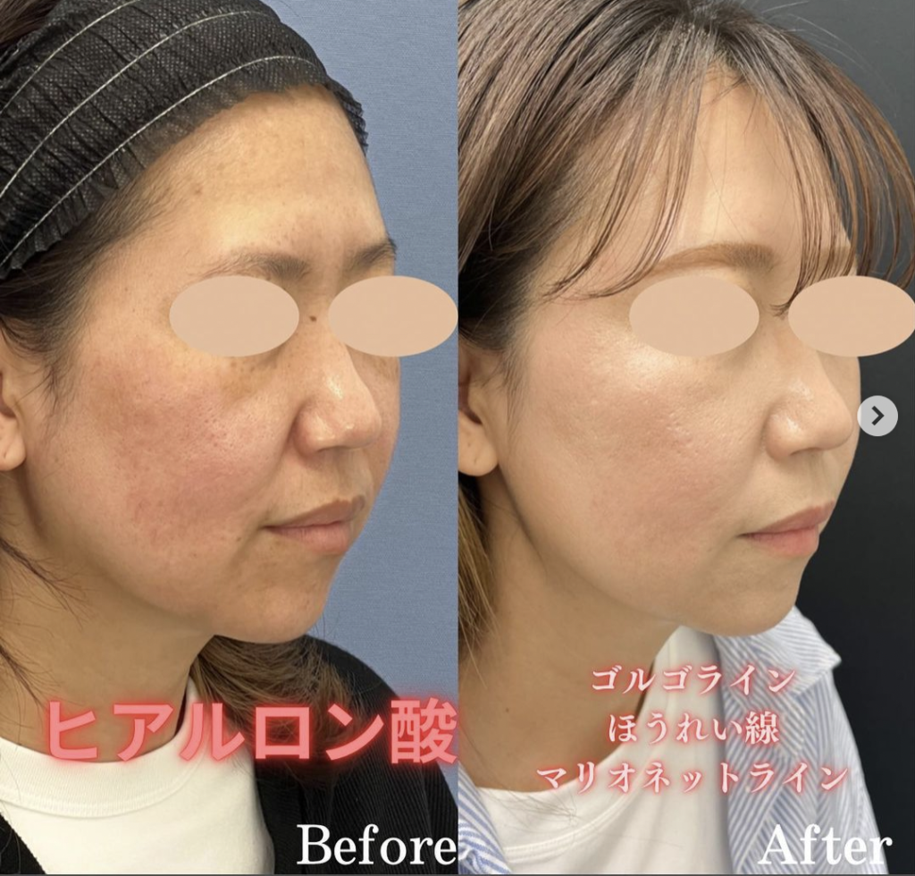 仙台でヒアルロン酸注入が安くて上手いおすすめクリニック8選｜コスパ良い名医はどこか口コミ評判を調査 | Beauty Park Clinic