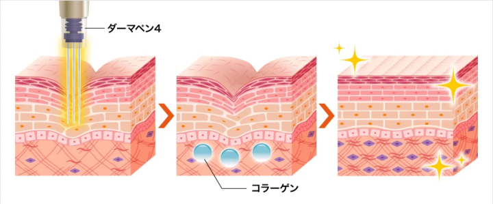 TCB東京中央美容外科　ダーマペン4