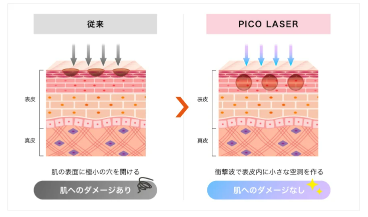 TCB東京中央美容外科 福岡　CO2フラクショナルレーザーメカニズム