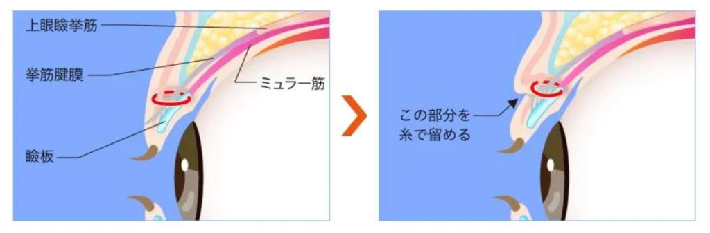 TCB東京中央美容外科 瞼板法