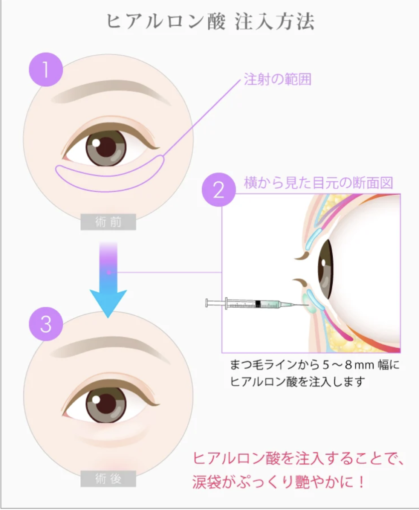 涙袋ヒアルロン酸　注入方法　TCB