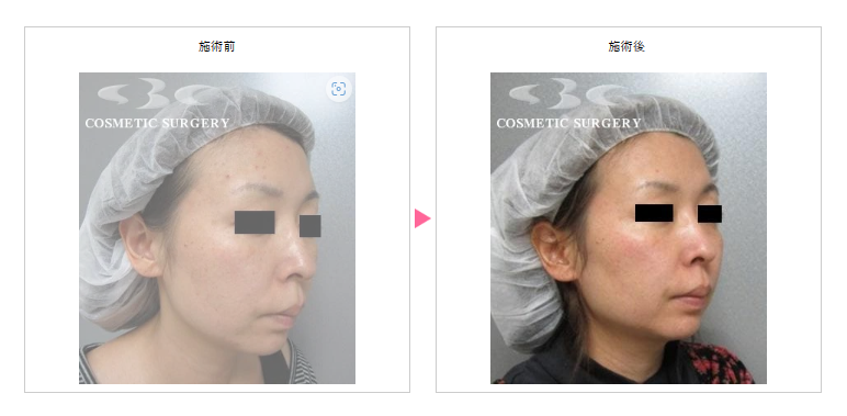 湘南美容クリニック　福岡　CO2フラクショナルレーザー症例写真
