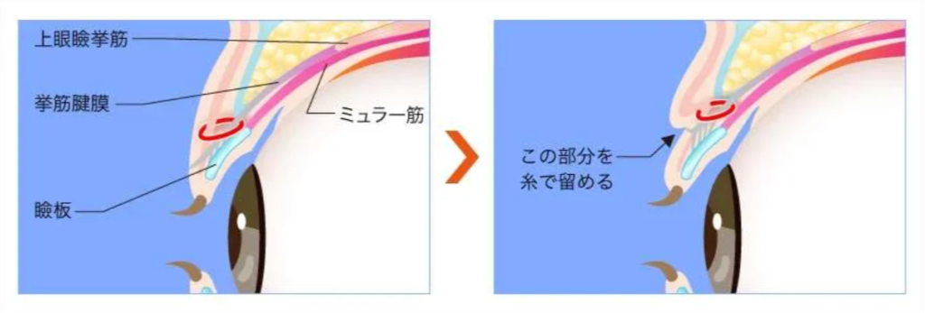 TCB東京中央美容外科 挙筋法