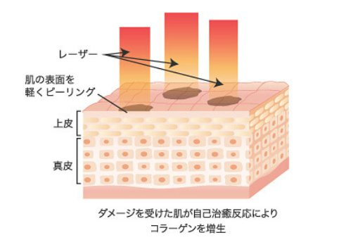 ガーデンクリニック　CO2フラクショナルレーザー　解説