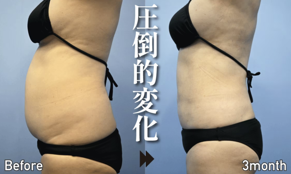 医療痩身ダイエット おすすめ