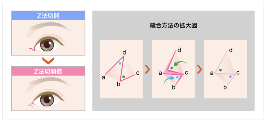 TCB 目頭切開　口コミ