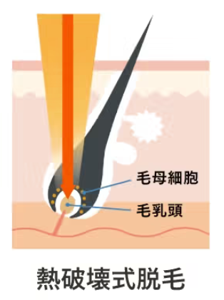 比較表付き】医療脱毛レーザー機器の種類はどれがいいか効果や違いも解説 | Beauty Park