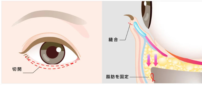 TCB東京中央美容外科　ハムラ法