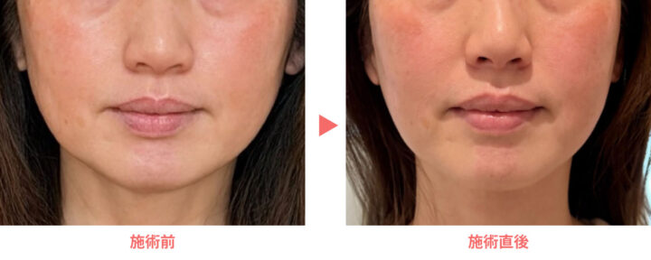 ルラ美容クリニック_オンダリフト_症例