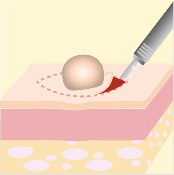 切開法（切除法）