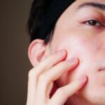 大阪でサブシジョン治療が安いおすすめのクリニック7選！諦めていたニキビ跡のへこみを改善しよう