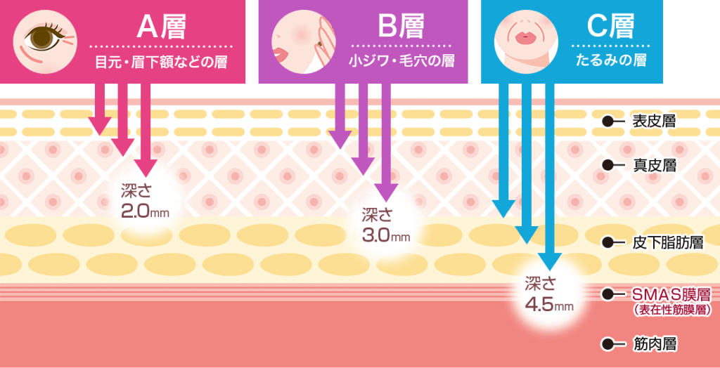 品川美容外科＿ソノクイーン