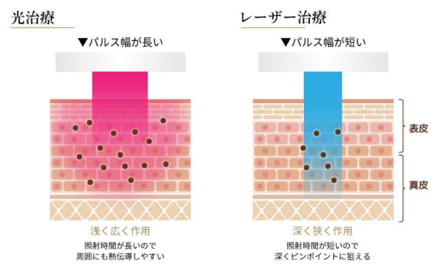 レーザートーニングフォトフェイシャルの違い