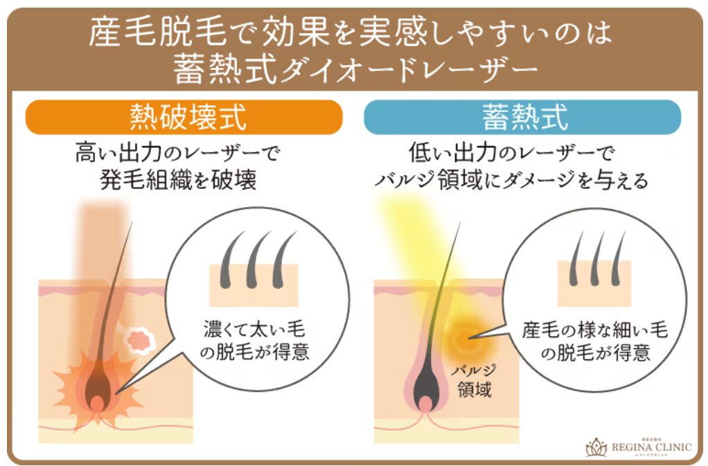 レジーナクリニック「蓄熱式と熱破壊式」の比較画像