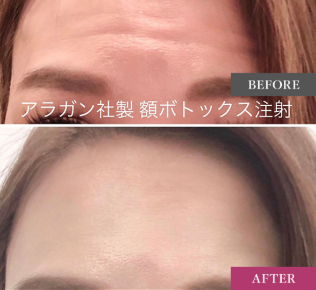 ルラ美容クリニック ボトックス症例