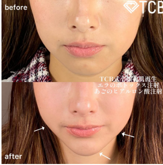 TCB東京中央美容外科　エラボトックス症例