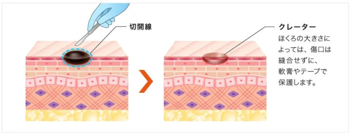 TCB東京中央美容外科　ほくろ　くりぬき