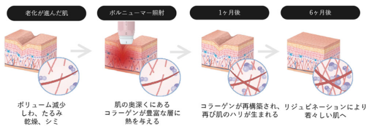 なとり皮膚科くまのどう内科下肢静脈瘤クリニック　ボルニューマ