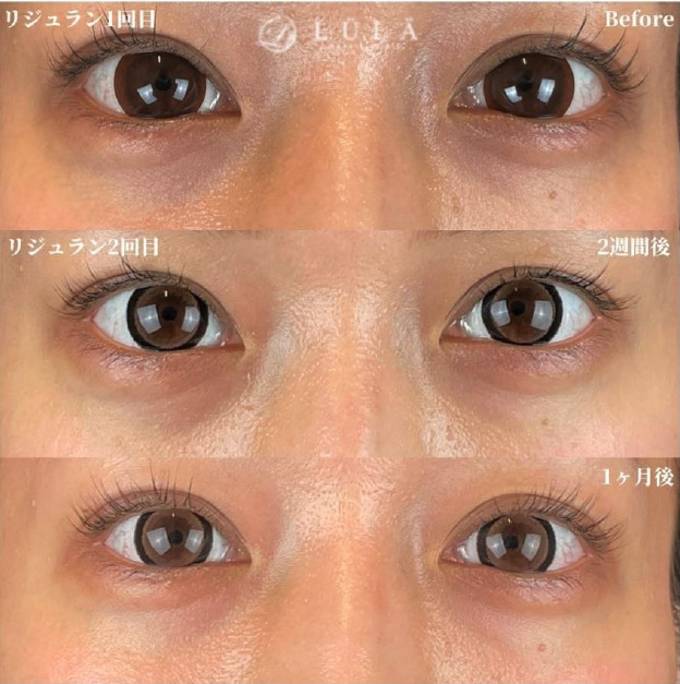 リジュラン症例 ルラ2