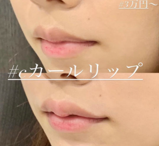 ルラ美容クリニック　Cカールリップ症例