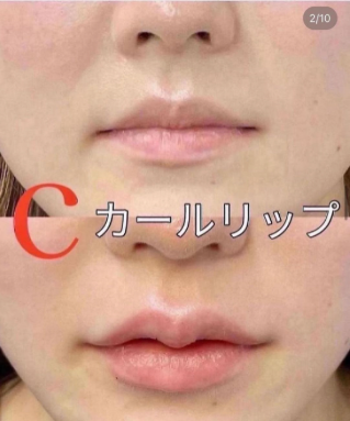 ルラ美容クリニック　Cカールリップ症例