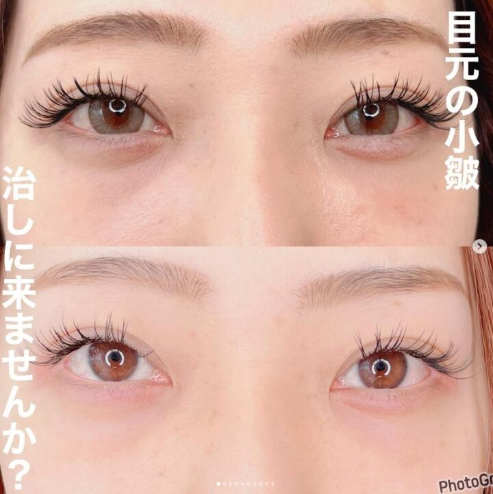 リジュラン症例 ルラ