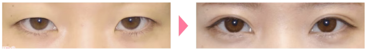 湘南美容クリニック　目頭切開　症例画像
