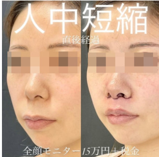 ルラ美容クリニック　人中短縮手術