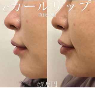 ルラ美容クリニック　Cカールリップ症例